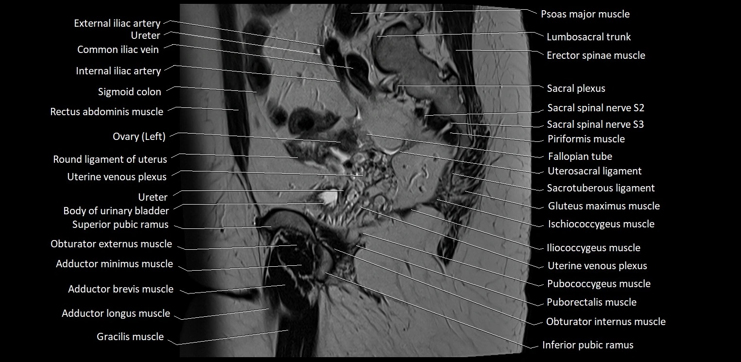 Sagittal cross sectional anatomy of female pelvis (MRI 3T) image 30.webp